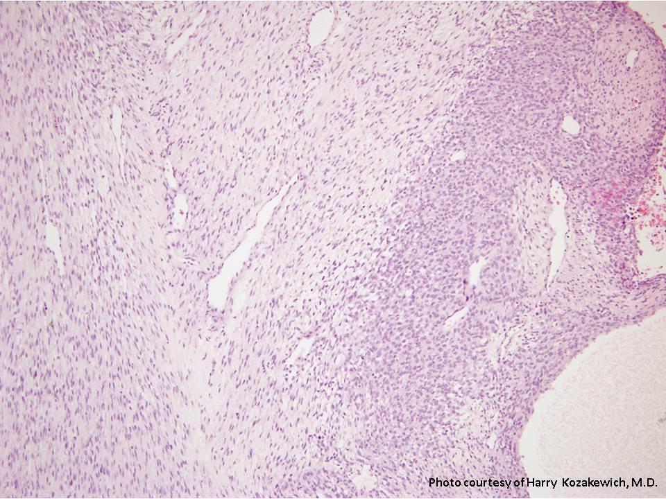 Mesoblastic Nephroma Pediatric Surgery Nat