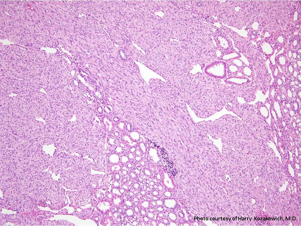 Mesoblastic Nephroma Pediatric Surgery Nat