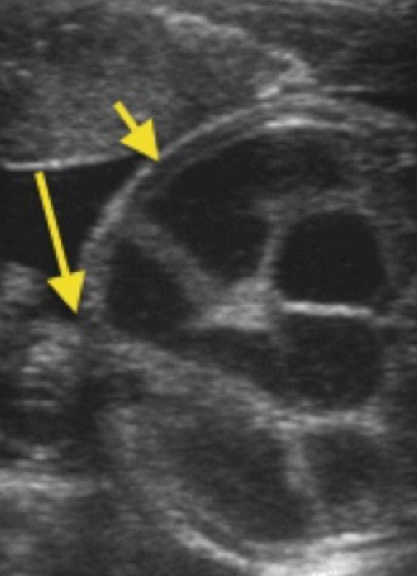 Gastroschisis Pediatric Surgery NaT
