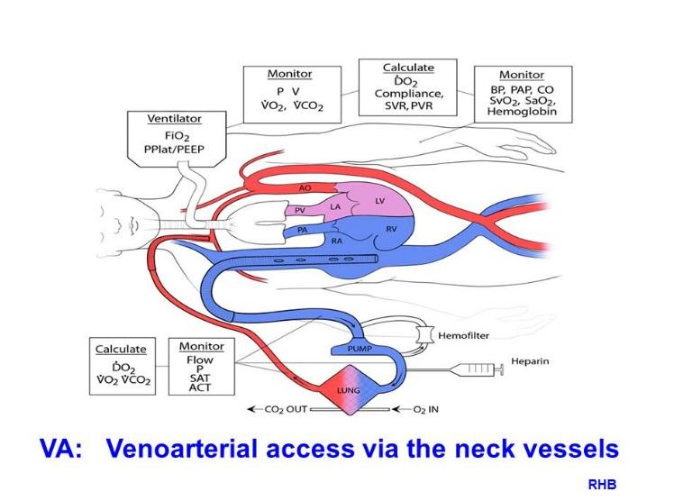 Extracorporeal Life Support Pediatric Surgery Nat