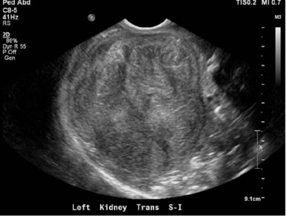 Mesoblastic Nephroma Pediatric Surgery Nat