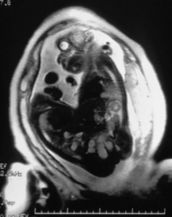 Ischiopagus Urological Problems In Conjoined Twins Wilcox 1998