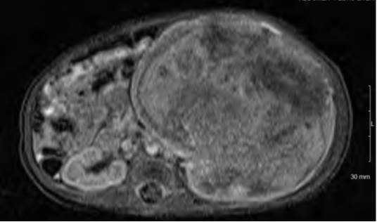 Mesoblastic Nephroma Pediatric Surgery Nat