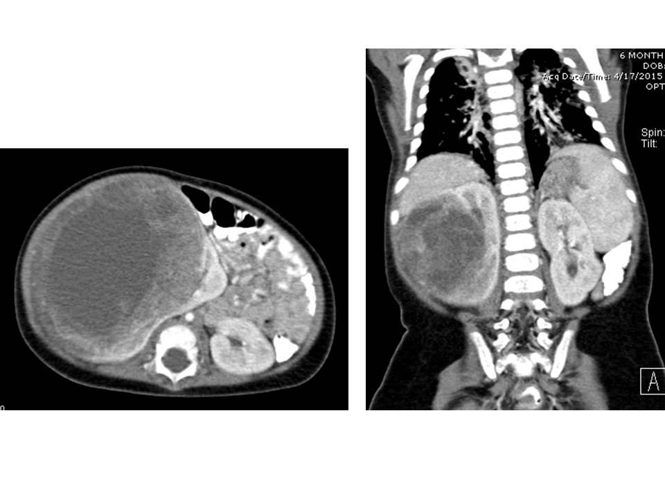 Mesoblastic Nephroma Pediatric Surgery Nat