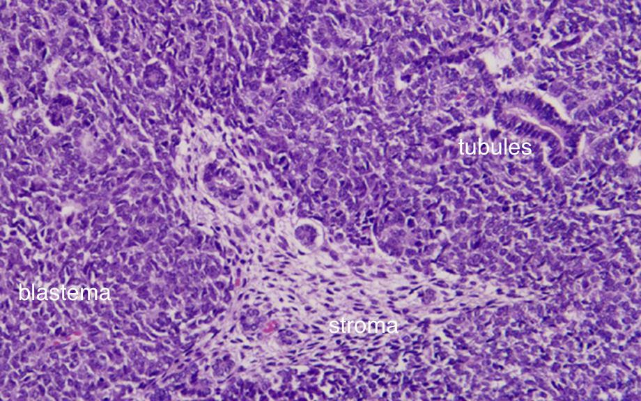 Wilms Tumor Pediatric Surgery Nat