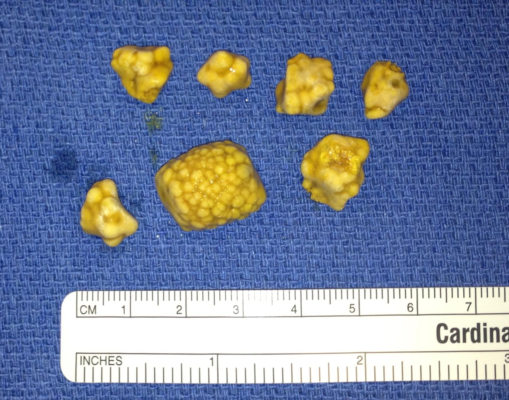 Gallbladder Disease