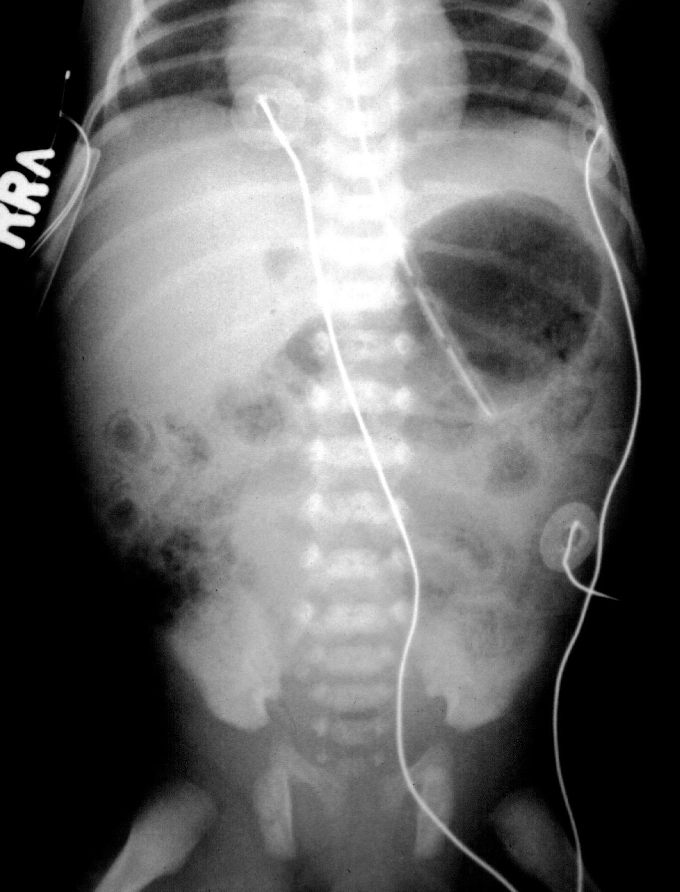 Necrotizing Enterocolitis Pediatric Surgery NaT