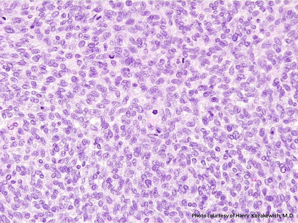 Mesoblastic Nephroma Pediatric Surgery Nat